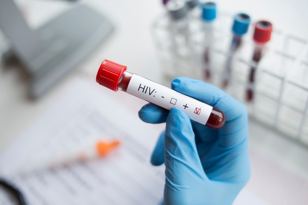 Ολλανδία: Εντοπίστηκε νέα πιο μεταδοτική παραλλαγή του ιού HIV – Πιθανό να κυκλοφορεί από το 1990