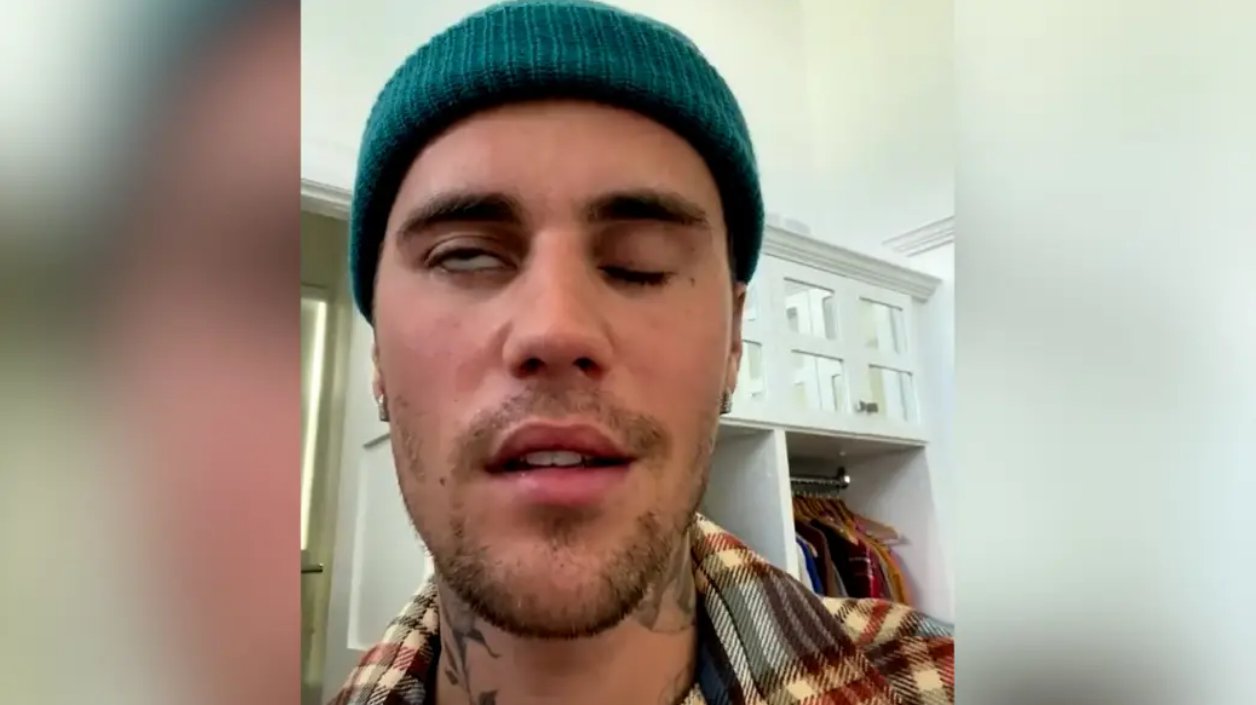 Justin Bieber: Διαγνώστηκε με σπάνιο σύνδρομο – Έχει παραλύσει η μία πλευρά του προσώπου του