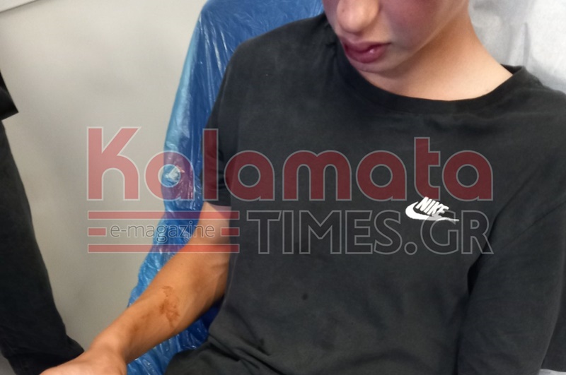 Καλαμάτα: Άγριος ξυλοδαρμός 16χρονου από συνομήλικούς του – Μεταφέρθηκε γεμάτος μώλωπες στο νοσοκομείο