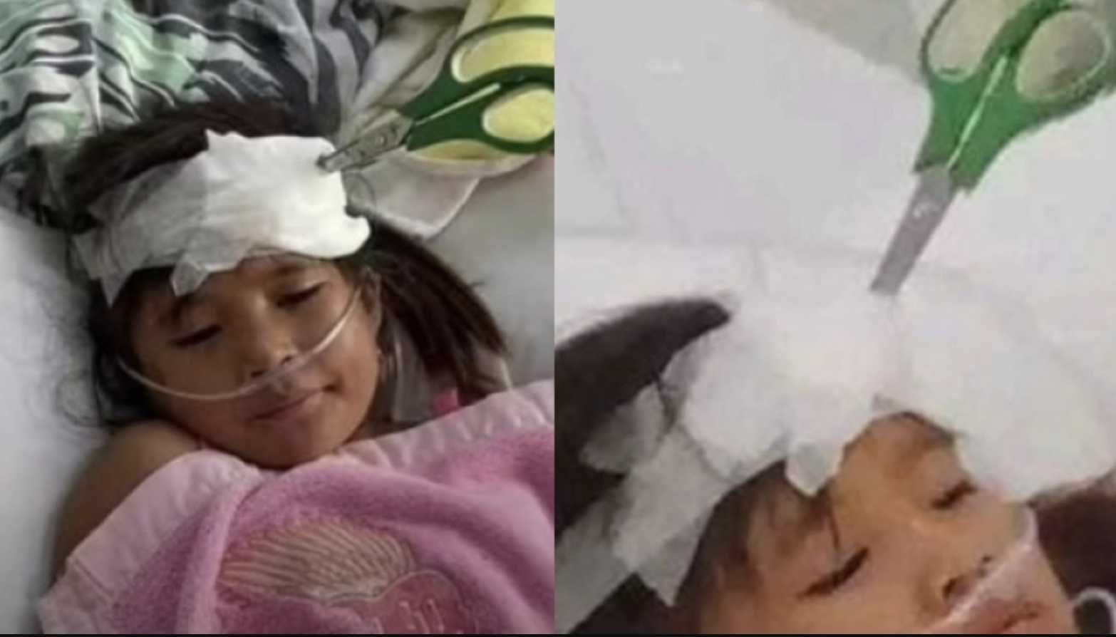 Έμεινε για μια εβδομάδα με καρφωμένο ψαλίδι στο κεφάλι: Της το πέταξε ο αδελφός της μετά από καυγά