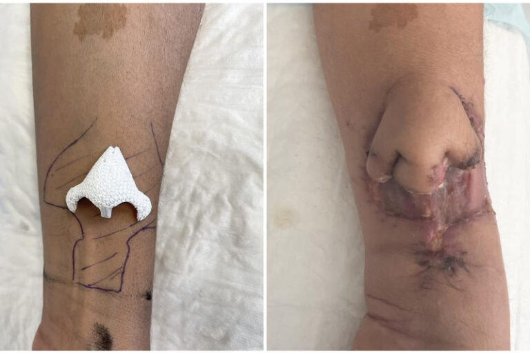 Γαλλία: Μεταμόσχευση τρισδιάστατα εκτυπωμένης μύτης σε γυναίκα που έχασε μέρος του προσώπου της από καρκίνο