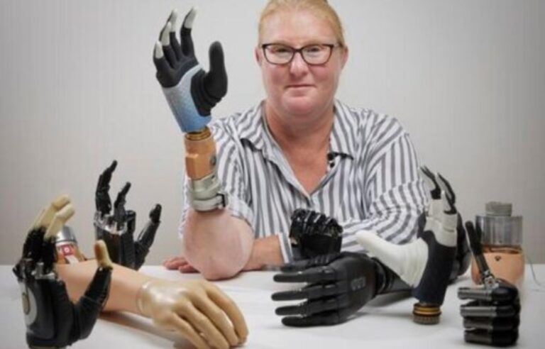 Σουηδία: Η πρώτη «βιονική» γυναίκα στον κόσμο με ρομποτικό χέρι ενσωματωμένο στον σκελετό