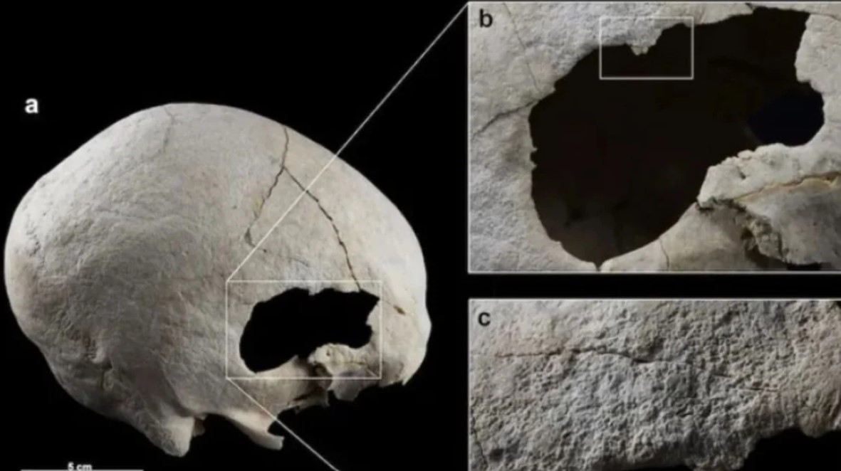 Ισπανία: Επιστήμονες βρήκαν αρχαίο κρανίο με δύο τρύπες – Τι ανακάλυψαν